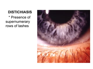 DISTICHIASIS
  * Presence of
supernumerary
rows of lashes
 