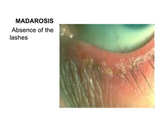 MADAROSIS
 Absence of the
lashes
 