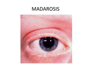 MADAROSIS
 