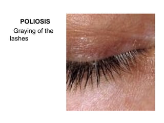 POLIOSIS
  Graying of the
lashes
 