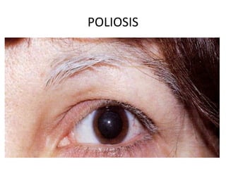 POLIOSIS
 