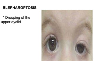 BLEPHAROPTOSIS

 * Drooping of the
upper eyelid
 