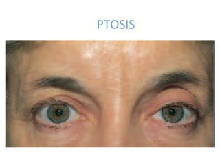 PTOSIS
 