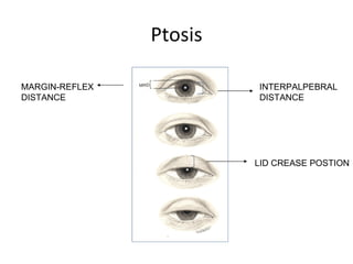 Ptosis

MARGIN-REFLEX            INTERPALPEBRAL
DISTANCE                 DISTANCE




                         LID CREASE POSTION
 