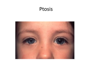Ptosis
 