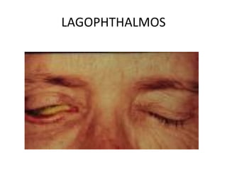 LAGOPHTHALMOS
 