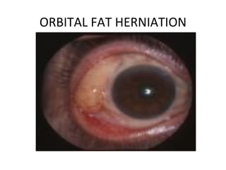 ORBITAL FAT HERNIATION
 