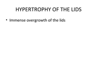 HYPERTROPHY OF THE LIDS
• Immense overgrowth of the lids
 