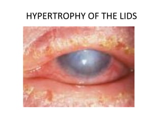 HYPERTROPHY OF THE LIDS
 