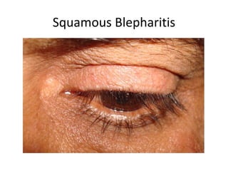 Squamous Blepharitis
 