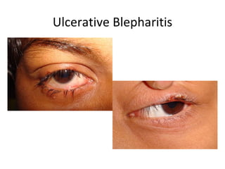 Ulcerative Blepharitis
 