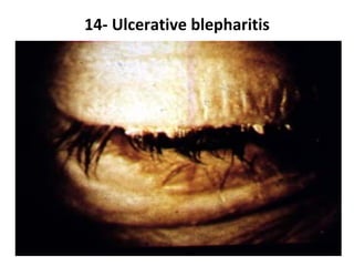 14- Ulcerative blepharitis
 
