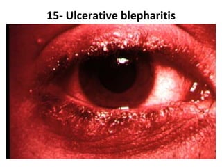 15- Ulcerative blepharitis
 