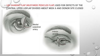 • LID-SHARING FLAP (MUSTARDE PEDICLED FLAP) USED FOR DEFECTS OF THE
CENTRAL UPPER LIDFLAP DIVIDED ABOUT WEEK 6 AND DONOR SITE CLOSED
PRIMARILY.
 