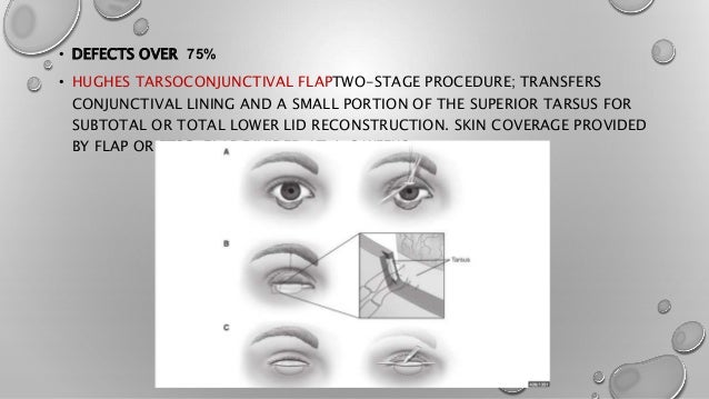 Eyelid reconstraction