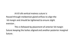 A 6 0 silk vertical matress suture is
Passed through meibomian gland orifices to align the
lid margin and should be tightened to ensure slight
eversion .
This is followed by placement of anterior lid margin
Suture keeping the lashes aligned and another posterior marginal
Suture.
 