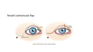 Tenzel’s semicircular flap
 