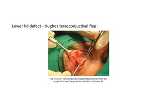 Lower lid defect - Hughes tarsoconjuctival flap :
 
