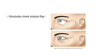 • Mustardes cheek rotation flap :
 