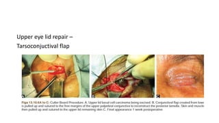 Upper eye lid repair –
Tarsoconjuctival flap
 
