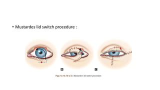 • Mustardes lid switch procedure :
 