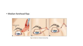 • Median forehead flap:
 