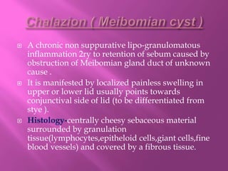  A chronic non suppurative lipo-granulomatous
inflammation 2ry to retention of sebum caused by
obstruction of Meibomian gland duct of unknown
cause .
 It is manifested by localized painless swelling in
upper or lower lid usually points towards
conjunctival side of lid (to be differentiated from
stye ).
 Histology-centrally cheesy sebaceous material
surrounded by granulation
tissue(lymphocytes,epitheloid cells,giant cells,fine
blood vessels) and covered by a fibrous tissue.
 