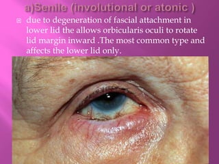  due to degeneration of fascial attachment in
lower lid the allows orbicularis oculi to rotate
lid margin inward .The most common type and
affects the lower lid only.
 