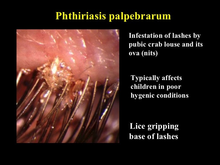 Pubic lice treatment picture