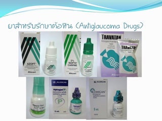 ยาส้าหรับรักษาต้อหิน (Antiglaucoma Drugs)
 