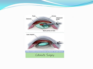 Cataracts Surgery
 