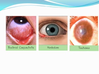 Bacterial Conjunctivitis   Hordeolum   Trachoma
 