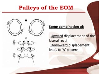 Pulleys of the EOM
Some combination of:
Upward displacement of the
lateral recti
Downward displacement
leads to ‘A’ pattern
 