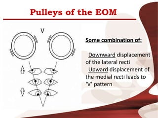 Pulleys of the EOM
Some combination of:
Downward displacement
of the lateral recti
Upward displacement of
the medial recti leads to
‘V’ pattern
 