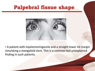 Palpebral fissue shape
• A patient with myelomeningocele and a straight lower lid margin
simulating a mongoloid slant. This is a common but unexplained
finding in such patients.
 