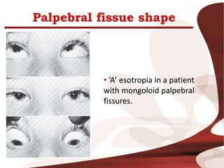 Palpebral fissue shape
• ‘A’ esotropia in a patient
with mongoloid palpebral
fissures.
 