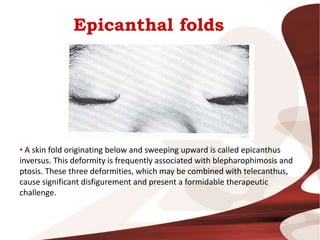 Epicanthal folds
• A skin fold originating below and sweeping upward is called epicanthus
inversus. This deformity is frequently associated with blepharophimosis and
ptosis. These three deformities, which may be combined with telecanthus,
cause significant disfigurement and present a formidable therapeutic
challenge.
 