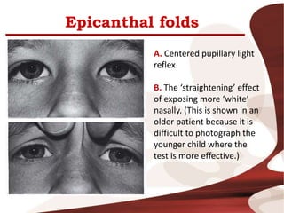 Epicanthal folds
A. Centered pupillary light
reflex
B. The ‘straightening’ effect
of exposing more ‘white’
nasally. (This is shown in an
older patient because it is
difficult to photograph the
younger child where the
test is more effective.)
 