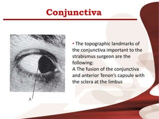Conjunctiva
• The topographic landmarks of
the conjunctiva important to the
strabismus surgeon are the
following:
A The fusion of the conjunctiva
and anterior Tenon’s capsule with
the sclera at the limbus
 