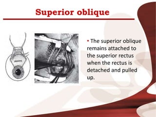 Superior oblique
• The superior oblique
remains attached to
the superior rectus
when the rectus is
detached and pulled
up.
 