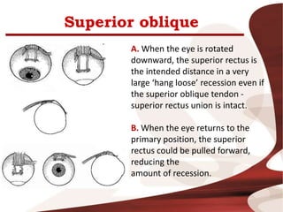Superior oblique
A. When the eye is rotated
downward, the superior rectus is
the intended distance in a very
large ‘hang loose’ recession even if
the superior oblique tendon -
superior rectus union is intact.
B. When the eye returns to the
primary position, the superior
rectus could be pulled forward,
reducing the
amount of recession.
 