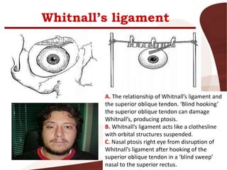 Whitnall’s ligament
A. The relationship of Whitnall’s ligament and
the superior oblique tendon. ‘Blind hooking’
the superior oblique tendon can damage
Whitnall’s, producing ptosis.
B. Whitnall’s ligament acts like a clothesline
with orbital structures suspended.
C. Nasal ptosis right eye from disruption of
Whitnall’s ligament after hooking of the
superior oblique tendon in a ‘blind sweep’
nasal to the superior rectus.
 