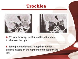 Trochlea
A. CT scan showing trochlea on the left and no
trochlea on the right.
B. Same patient demonstrating the superior
oblique muscle on the right and no muscle on the
left.
 