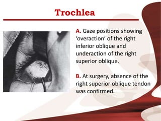 Trochlea
A. Gaze positions showing
‘overaction’ of the right
inferior oblique and
underaction of the right
superior oblique.
B. At surgery, absence of the
right superior oblique tendon
was confirmed.
 
