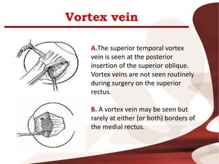 Vortex vein
A.The superior temporal vortex
vein is seen at the posterior
insertion of the superior oblique.
Vortex veins are not seen routinely
during surgery on the superior
rectus.
B. A vortex vein may be seen but
rarely at either (or both) borders of
the medial rectus.
 