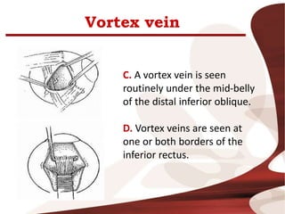 Vortex vein
C. A vortex vein is seen
routinely under the mid-belly
of the distal inferior oblique.
D. Vortex veins are seen at
one or both borders of the
inferior rectus.
 