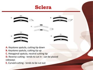Sclera
A. Keystone spatula, cutting tip down
B. Keystone spatula, cutting tip up
C. Hexagonal spatula, neutral cutting tip
D. Reverse cutting - tends to cut in - can be placed
sideways
E. Curved cutting - tends to be cut out
 