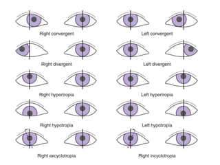 Inward Rotation Of Eye Eye and its disorders in anatomy and physiology | PPTX
