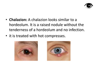 • Chalazion: A chalazion looks similar to a
hordeolum. It is a raised nodule without the
tenderness of a hordeolum and no infection.
• it is treated with hot compresses.
 