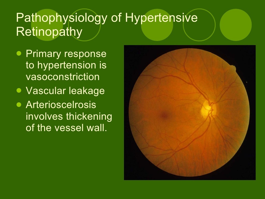 Hypertensive Retinopathy